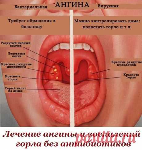 Лечение ангины и воспалений горла без антибиотиков А можно ли вылечить ангину без антибиотиков? Такой вопрос у меня впервые возник опять же во время беременности.