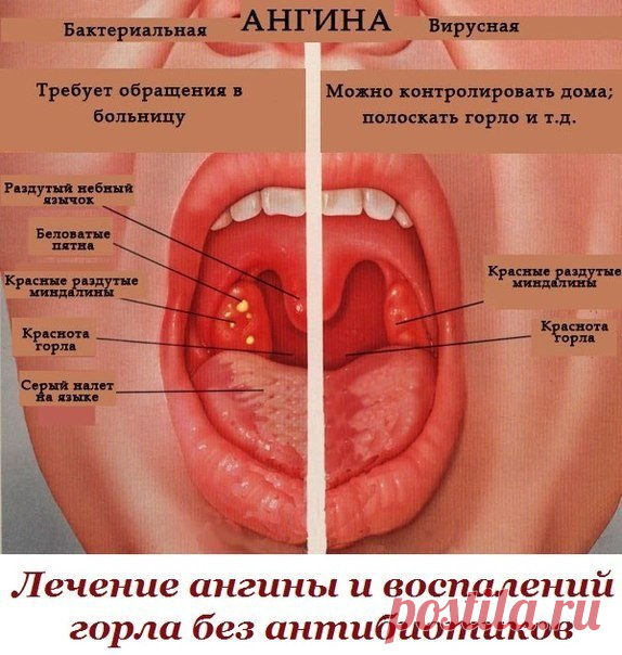Лечение ангины и воспалений горла без антибиотиков А можно ли вылечить ангину без антибиотиков? Такой вопрос у меня впервые возник опять же во время беременности.