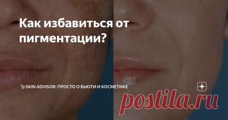 Как избавиться от пигментации? Статья автора «✨BEAUTY PLEASURE: просто о бьюти и косметике» в Дзене ✍: ✨Как избавиться от пигментации Скажу честно: одного средства, волшебной палочки от пигментных пятен нет.