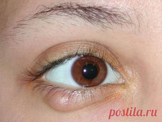 Как вылечить ячмень на глазу?