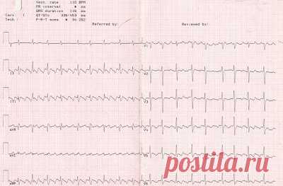 Скорая медицинская помощь: Фибрилляция, трепетание предсердий - Fibrillatio, trepidatio atriorum