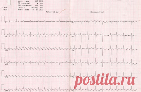 Скорая медицинская помощь: Фибрилляция, трепетание предсердий - Fibrillatio, trepidatio atriorum