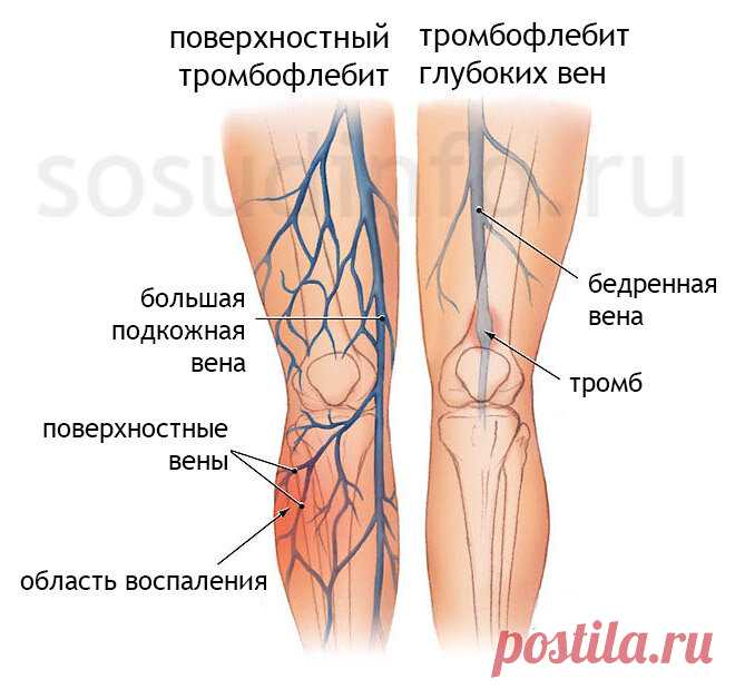 ПЕРВЫЕ СИМПТОМЫ ТРОМБА В НОГЕ | DonorSearch - Сообщество доноров | Яндекс Дзен
