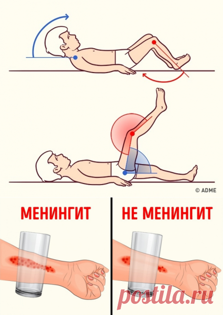 8 симптомов менингита, о которых должен знать каждый родитель