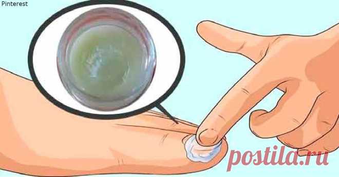 Вот лучшее домашнее средство для уничтожения грибка на ногтях