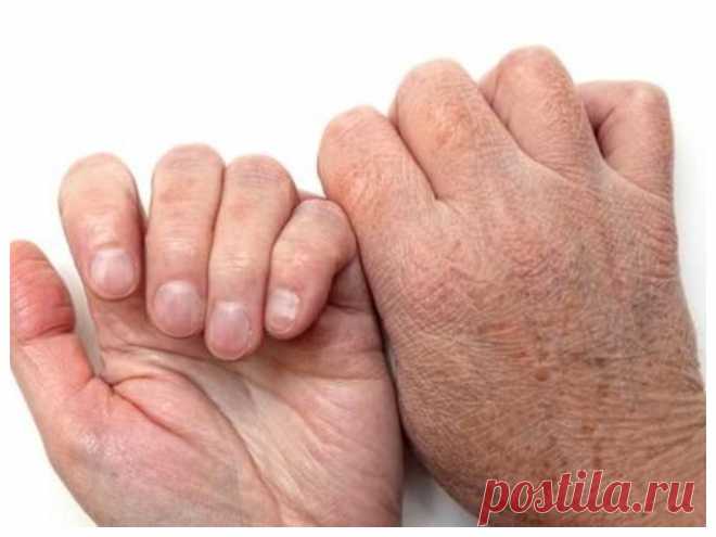 Заболевания сердца: предупреждающие знаки на нашей коже