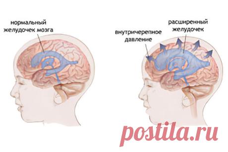 Внутричерепное давление – лечение внутричерепного давления народными средствами и методами