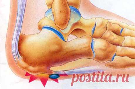 Пяточная шпора причины, симптомы и лечение в домашних условиях