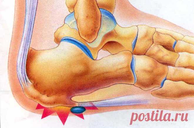 Пяточная шпора причины, симптомы и лечение в домашних условиях