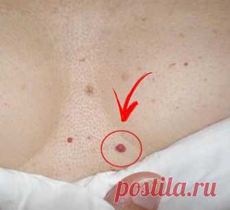 Что означают КРАСНЫЕ РОДИНКИ на теле Ангиомы, известные, как красные родинки, в медицинской практике принято относить к образованиям доброкачественного характера, которые состоят из лимфатических или кровеносных сосудов. Их появление объясняется нарушениями функционирования либо кровеносной, либо лимфатической систем
