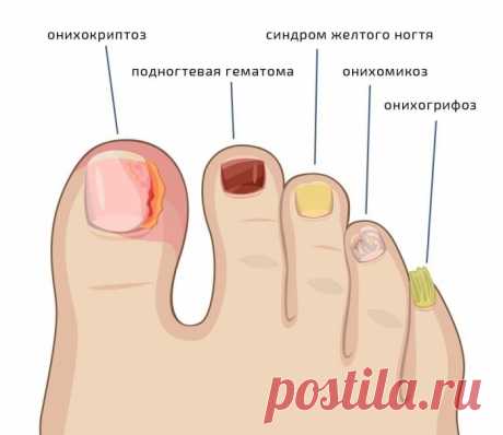 ОТЛИЧНЫЙ РЕЦЕПТ ДЛЯ ЛЕЧЕНИЯ ГРИБКА