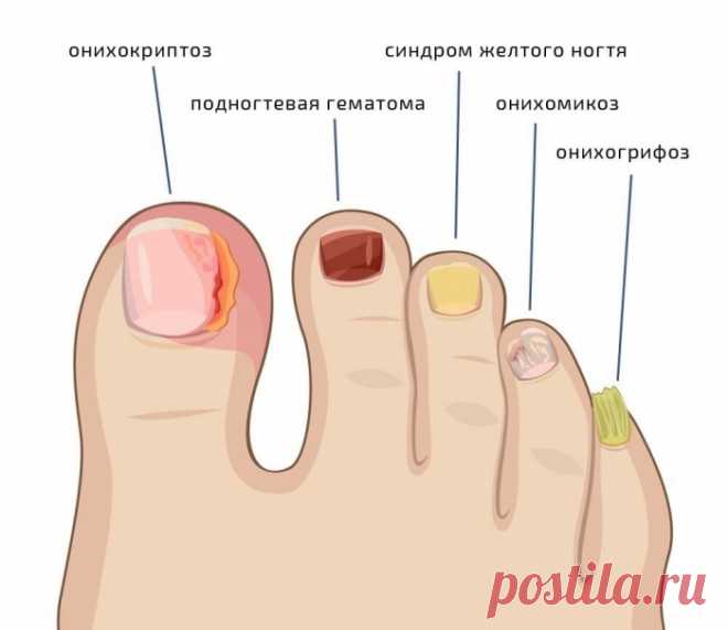 ОТЛИЧНЫЙ РЕЦЕПТ ДЛЯ ЛЕЧЕНИЯ ГРИБКА