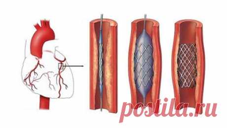 Стентирование сердца - сколько живут после операции