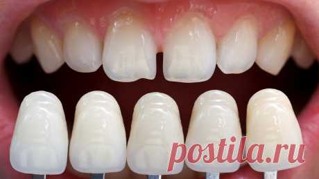 Установка виниров цена волгоград 
Snap-On Smile – это 2 в 1: элайнеры и виниры!
- Скрывают неравномерные зубы или большие пробелы между зубами
- Утаивают полное отсутствие одного или ряд зубов, сколотые зубы
- Помогут утаить потемневшие или утерявшие былую белизну зубы
- Правят прикус и равняют зубы
Забудьте об этих проблемах на веки веков!
Сломанные, искривленные, отсутствующие зубы впереди не добавляют нам всем притягательности и толкают от нас друзей. Вот поэтому  шезлонги для дачи
