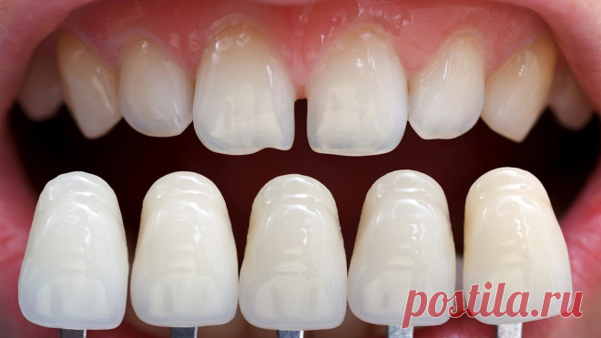 Установка виниров цена волгоград 
Snap-On Smile – это 2 в 1: элайнеры и виниры!
- Скрывают неравномерные зубы или большие пробелы между зубами
- Утаивают полное отсутствие одного или ряд зубов, сколотые зубы
- Помогут утаить потемневшие или утерявшие былую белизну зубы
- Правят прикус и равняют зубы
Забудьте об этих проблемах на веки веков!
Сломанные, искривленные, отсутствующие зубы впереди не добавляют нам всем притягательности и толкают от нас друзей. Вот поэтому  шезлонги для дачи