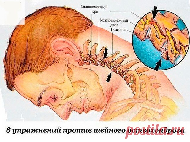 Восемь упражнений против шейного остеохондроза

Первые проявления шейного остеохондроза — боли в спине, головные боли, головокружение, 