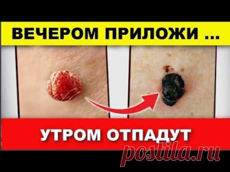 (24) Старый дерматолог : бородавки и папилломы легко растворяться домашними средствами , вот этими ... - YouTube