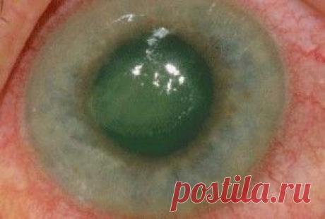 Катаракта - причины, симптомы, лечение, глазные капли, операция при катаракте