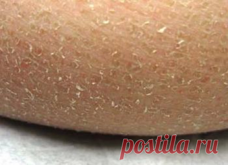 Ихтиоз ( патологическая сухость кожи) и как с ним бороться.