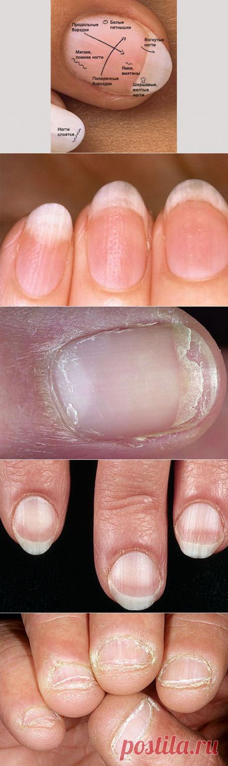 О чем расскажут ваши ногти – определяем болезни по ногтям