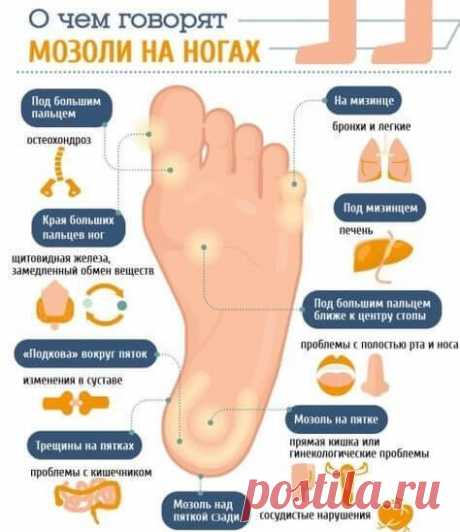 О чем говорят мозоли на ногах?