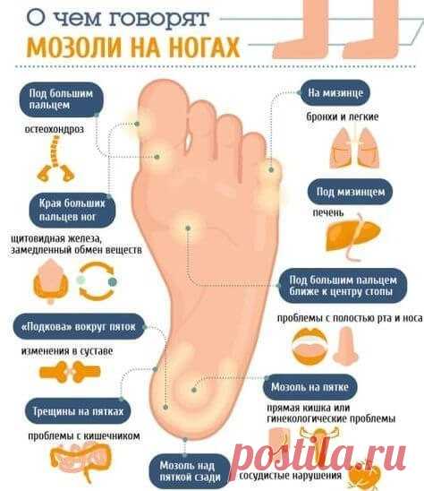 О чем говорят мозоли на ногах?