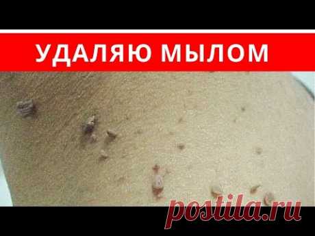 Как УДАЛИТЬ ПАПИЛЛОМЫ хозяйственным мылом