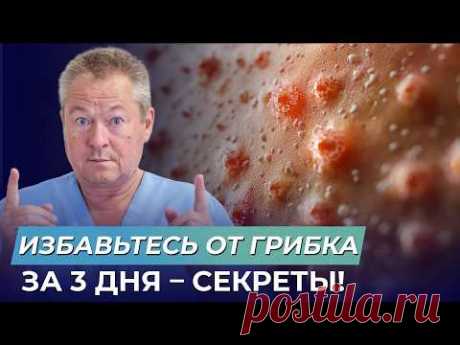 Как НАВСЕГДА избавиться от грибка в 2025 году?