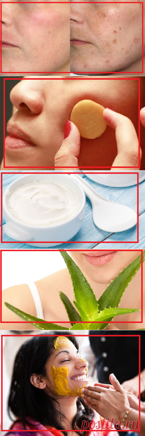 Как избавиться от пигментации: 5 простых и действенных способа | моя записная книжка | Яндекс Дзен