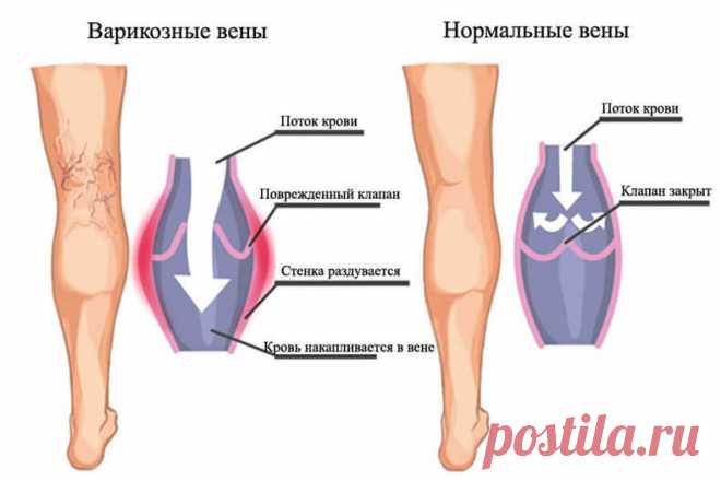 Упражнения Микулина. Варикозное расширение вен Варикозное расширение вен — заболевание вен, выражающееся в увеличении их размеров, изменении формы и уменьшении эластичности. Поражаются преимущественно поверхностные вены нижних конечностей, венозные сплетения прямой кишки, вены воротной системы и семенного канатика.