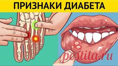 10 ранних признаков того, что у вас ДИАБЕТ. Многие игнорируют эти симптомы. Профилактика диабета