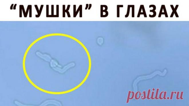 Откуда берутся «мушки» перед глазами? «Мушки», мельтешащие перед глазами, — это неприятно. Они двигаются в унисон и по той же траектории, что и глаза, раздражая и напрягая зрение. У некоторых людей от такого явления начинает болеть голова...