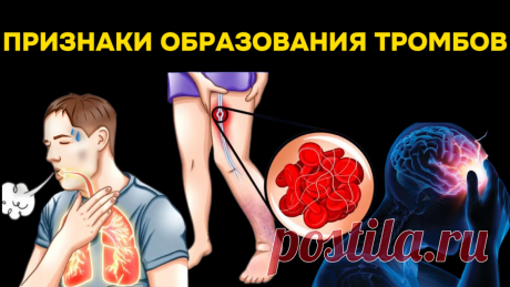 9 предупреждающих знаков образования тромбов, которые нельзя игнорировать | Игорь Ботоговский | Дзен
