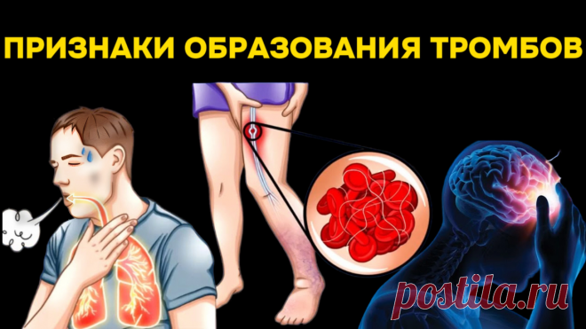 9 предупреждающих знаков образования тромбов, которые нельзя игнорировать | Игорь Ботоговский | Дзен