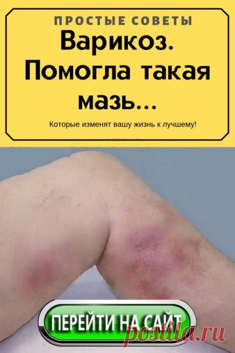 Варикозное расширение вен, это их удлинение, расширение, образование узлов и извилин. Лечить его пытались еще Гиппократ и Авиценна. И еще раньше, когда этих почтенных мужей на свете не было, люди искали средства избавления от болезни.