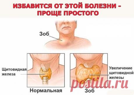 Народные советы . Лечение узлового зоба .