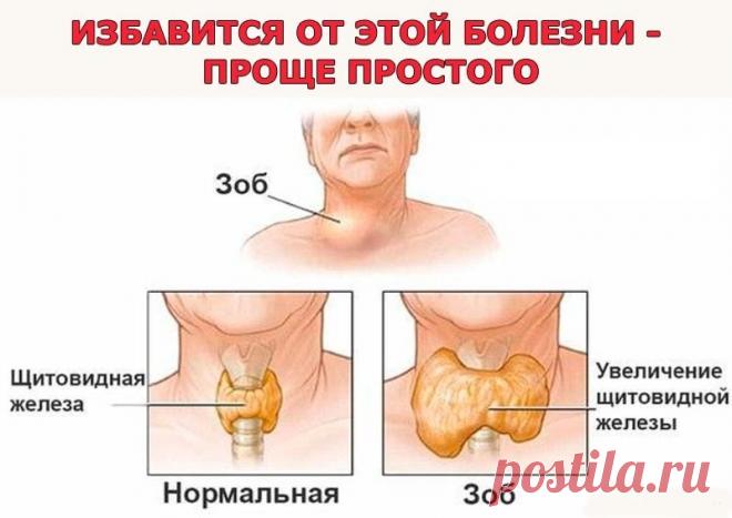 Народные советы . Лечение узлового зоба .