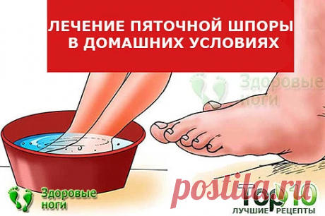 Топ-10 методов лечения пяточной шпоры в домашних условиях. Проверенные рецепты, как вылечить пяточную шпору на дому