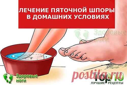 Топ-10 методов лечения пяточной шпоры в домашних условиях. Проверенные рецепты, как вылечить пяточную шпору на дому