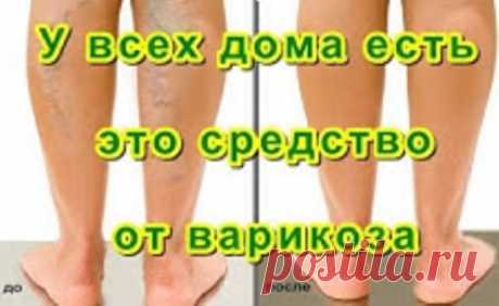 У ВСЕХ ДОМА ЕСТЬ ЭТО СРЕДСТВО ОТ ВАРИКОЗА, НО НИКТО О НЕМ НЕ ЗНАЕТ