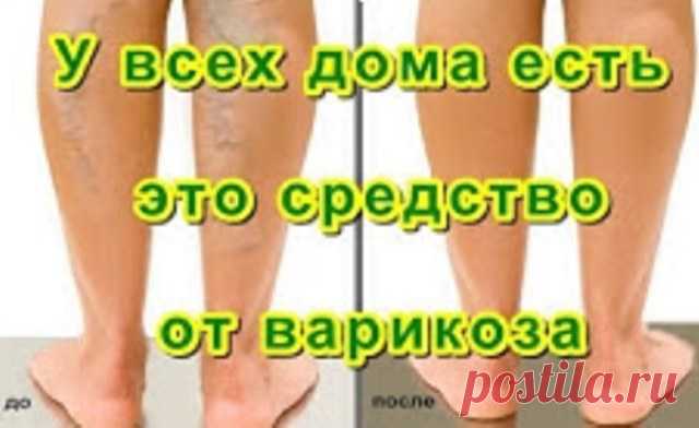 У ВСЕХ ДОМА ЕСТЬ ЭТО СРЕДСТВО ОТ ВАРИКОЗА, НО НИКТО О НЕМ НЕ ЗНАЕТ