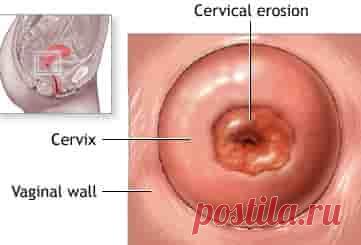 Эрозия шейки матки  (код МКБ-10; код МКБ-11): описание, причины, симптомы, как лечить | Клиника лечения боли: врачи онлайн