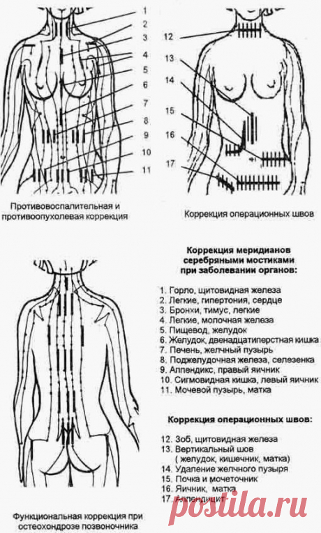 Серебряные мостики, пластырь для удаления рубцов и шрамов