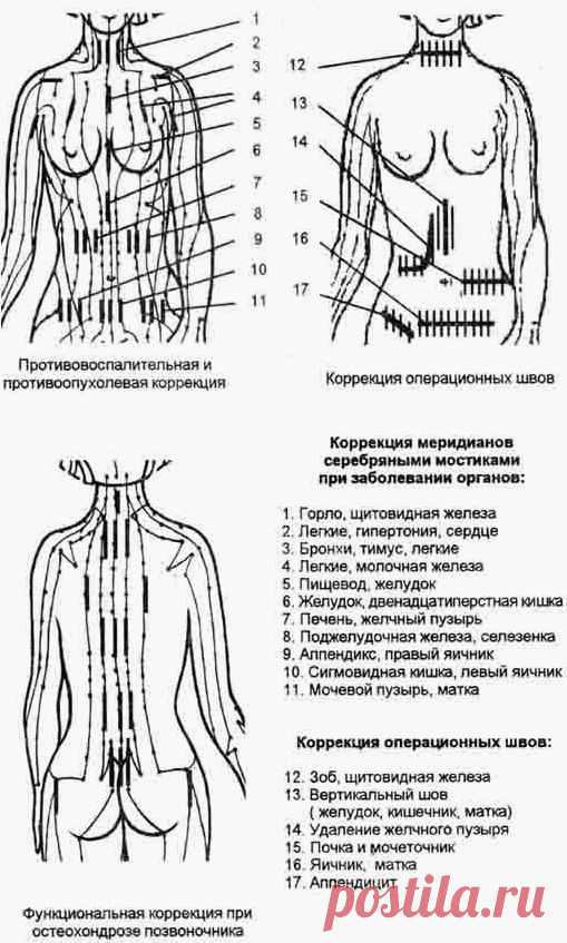 Серебряные мостики, пластырь для удаления рубцов и шрамов