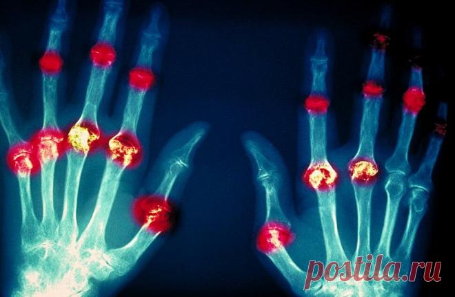 Ревматоидный артрит: причины поражения суставов, симптомы, лечение?
Для справки: ревматоидным артритом называется системное хроническое воспаление суставов, этиология которого медицинской науке пока доподлинно неизвестна. Это серьезное заболевание с разнообразной клиникой (течением), характеризующееся деструкцией (то есть разрушением, если кому-то непонятно) синовиальных суставов, а также...
Читай дальше на сайте. Жми подробнее ➡