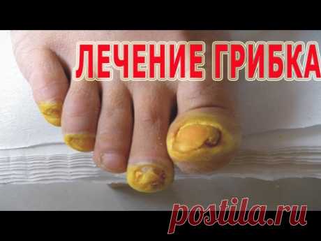★Лечение ГРИБКА НОГТЕЙ народными методами. 9 лучших рецептов против МИКОЗА.