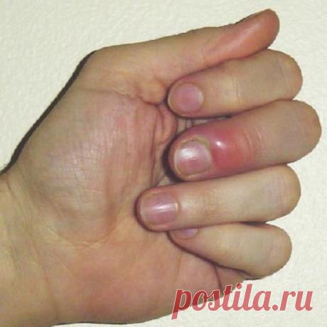 Народные средства лечения нарыва на пальце