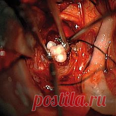 В мозге у мальчика нашли зуб! (Последствие ГМО?)