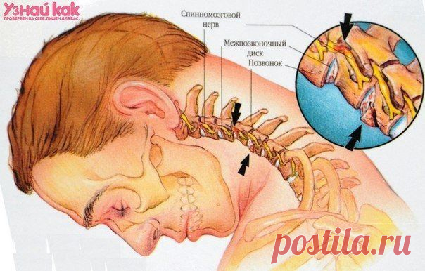 ЧТО ДЕЛАТЬ, ЕСЛИ БОЛИТ ШЕЯ