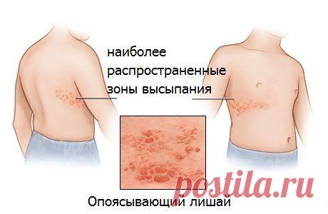 Что такое опоясывающий лишай (опоясывающий герпес)